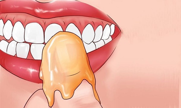 درمان دندان درد با عسل